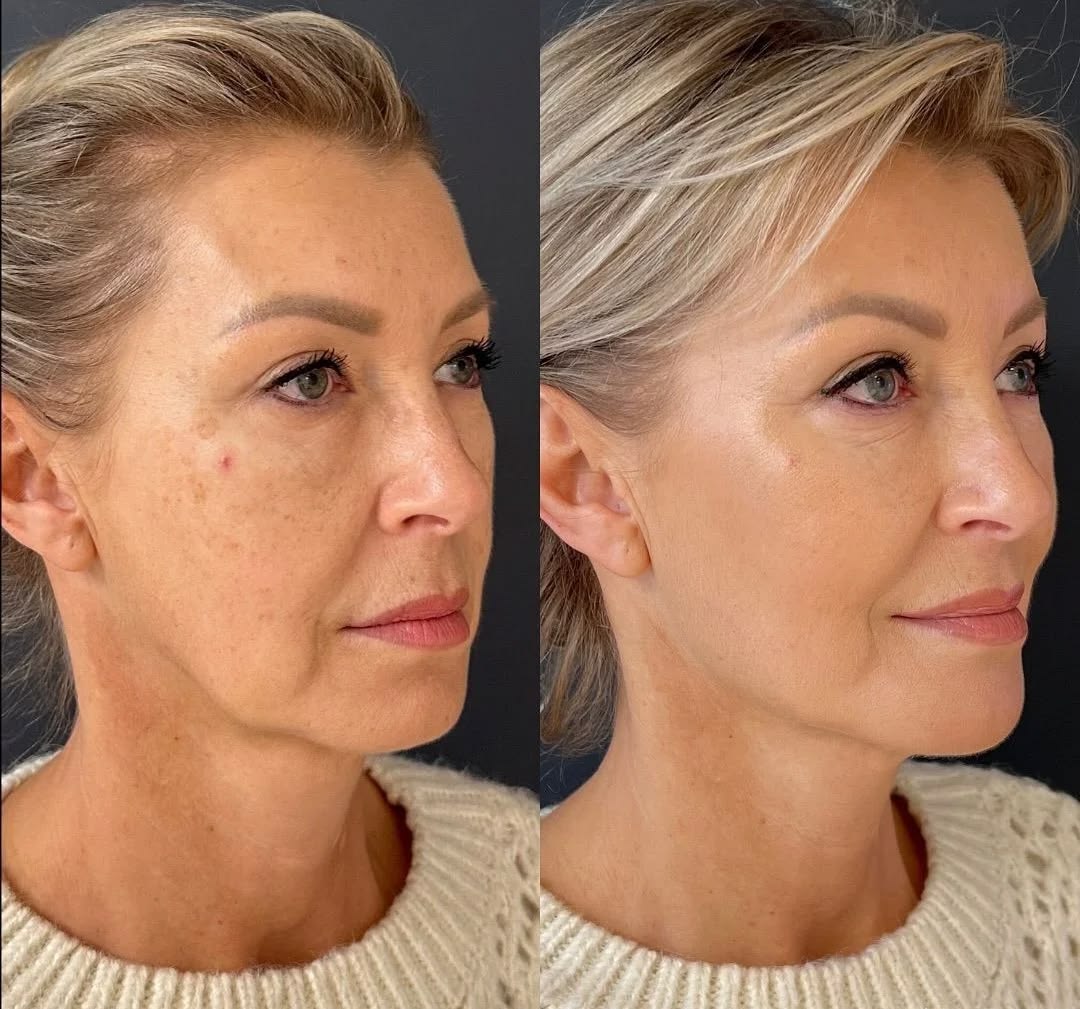 Instant Face Tightener